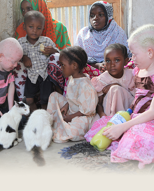 People with albinism face severe persecution 
